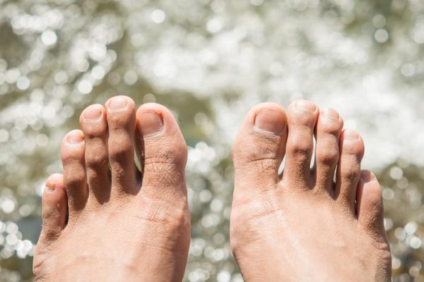 5 เรื่องน่ารู้เกี่ยวกับโรคน้ำกัดเท้า